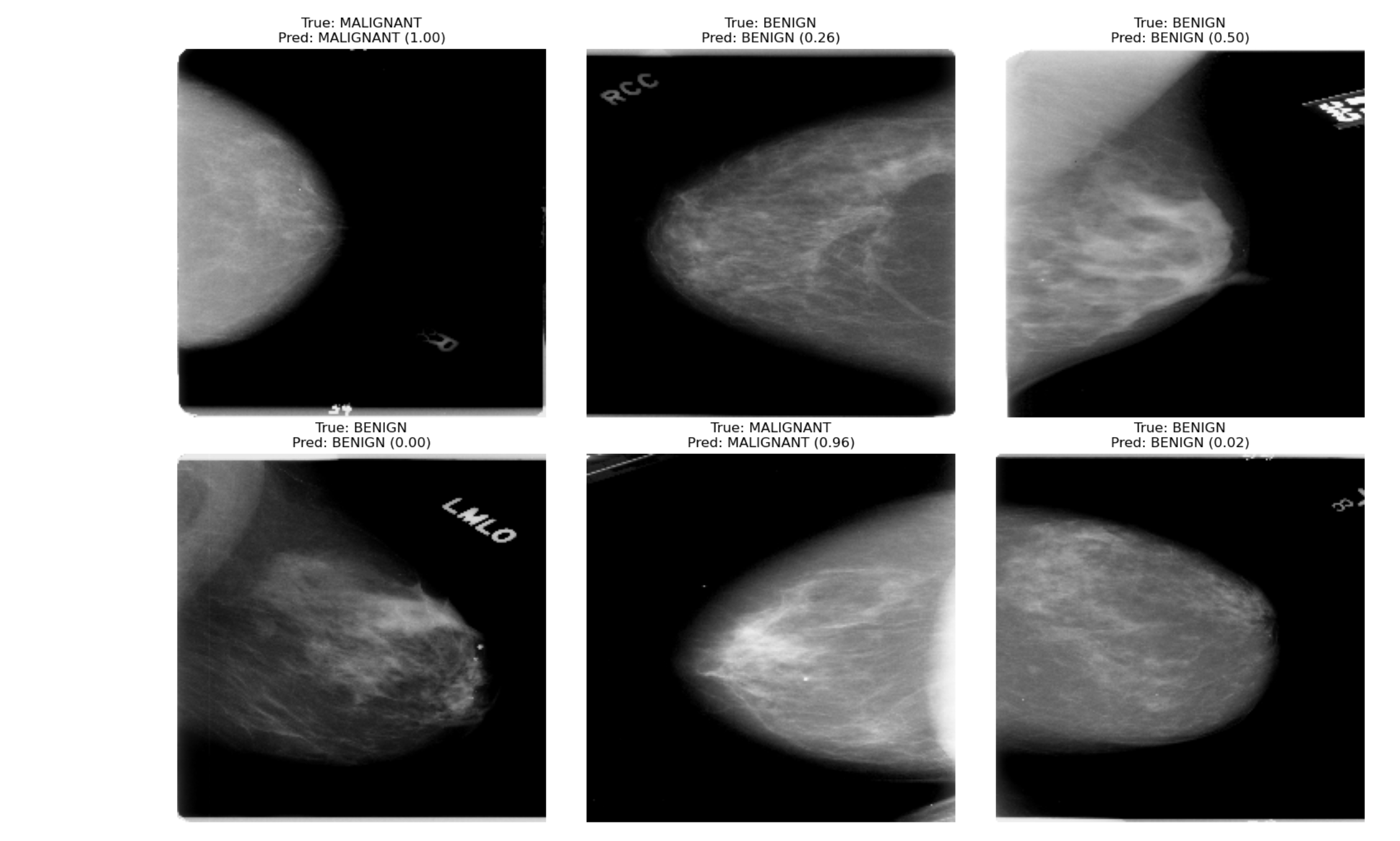 Breast Cancer Project
